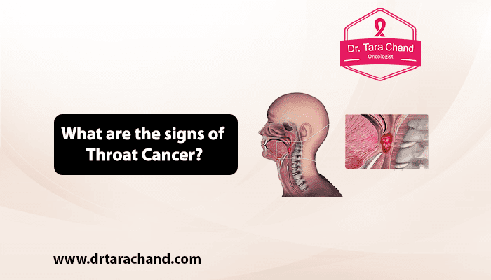 What are the Signs of Throat Cancer in 2022?