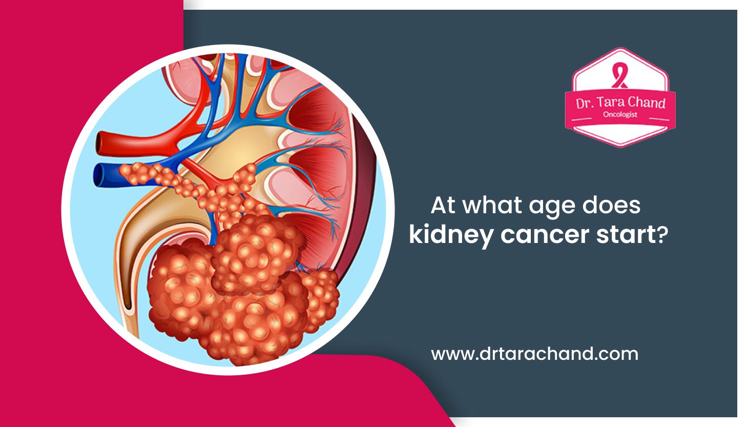 What age does kidney cancer start?